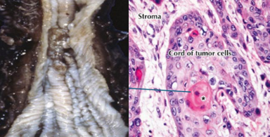 <p>esophageal squamous cell carcinoma (ESCC) risk factors? features? molecular?</p>