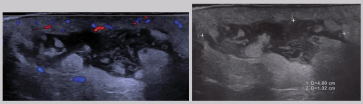 <ul><li><p><span style="background-color: transparent;">Caused by cuts, scrapes, crushing injuries, surgical trauma, etc.</span></p><ul><li><p><span style="background-color: transparent;">Abdominal wall abscesses are usually a surgical complication</span></p></li></ul></li><li><p><span style="background-color: transparent;">Clinical presentation - redness, pain, swelling, <u>elevated WBC (AKA leukocytosis)</u></span></p></li><li><p><span style="background-color: transparent;">US appearance:</span></p><ul><li><p><span style="background-color: transparent;">Heterogeneous</span></p></li><li><p><span style="background-color: transparent;">Hypoechoic fluid w/ echogenic debris</span></p></li><li><p><span style="background-color: transparent;">Irregular borders</span></p></li><li><p><span style="background-color: transparent;">Posterior enhancement</span></p></li><li><p><span style="background-color: transparent;">Peripheral hypervascularity</span></p></li></ul></li></ul><p></p>