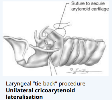 <p>Unilateral cricoarytenoid lateralization (“tie back” cartilage)</p>