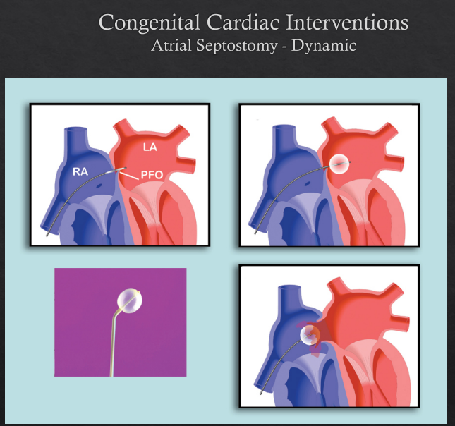 <p><strong><u>Mx</u></strong>: <em>nutrition, diuretics, ACEi, Surgical Closure</em></p><p><strong>First Line</strong>:</p><p><strong>Long Term: </strong>surgery (atrial septosomy, ASD closure)</p><p></p><p><strong>Cx</strong>: HF, pulmonary HTN (chronic left-to-tight shunt and AV valve regurg.)</p><p><strong><em>Assoc. Conditions: </em></strong>pulmonary atresia, Total Anomalous Pulmonary Venous Return</p>