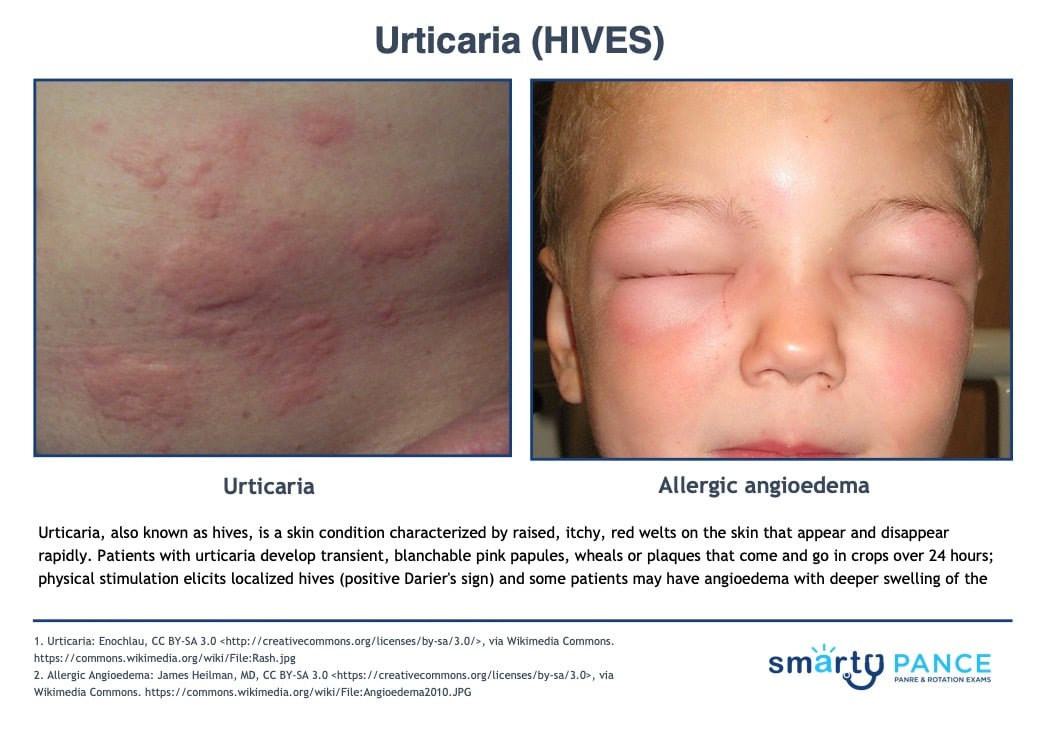 <p>Transient, well-circumscribed, itchy, pink wheals that blanch with pressure and resolve within 24 hours </p><p>-Types: acute (IgE mediated), chronic (idiopathic), dermatographism, angioedema </p><p>-Dx: clinical with history, CBC, CMP, thyroid function, ANA </p><p>-Tx: H1 antihistamines, short course of steroids </p>