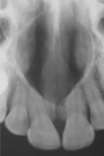 <p>heart shaped lesion in midline of anterior maxilla </p>