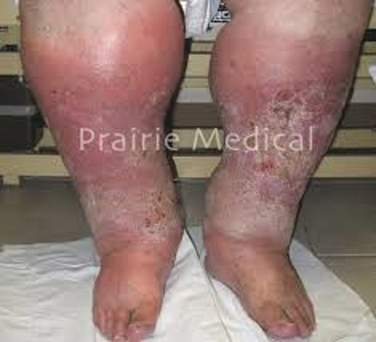 <p>constant, achy, fullness, pain. Pain gets better by moving. When you stand/sit pain gets worse. Gravity works against when legs are down. Usually happens on both legs, skin turns red/brown, starts below the knee to the ankle, skin is scaly, can get slits in skin (weeping edema), there is no cure, no change in skin temp.</p>