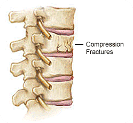 <p>Compressed </p>