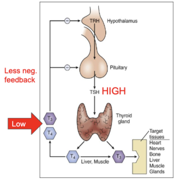 <p>The thyroid gland produces too little of T<sub>3</sub> and T<sub>4</sub></p><ul><li><p>Bodily reaction (less negative feedback loop): The hypothalamus and pituitary gland respond by increasing the levels of TRH and TSH, but something is inherently wrong with the thyroid, which continues to not produce enough T<sub>3</sub> and T<sub>4</sub></p></li></ul><p></p>