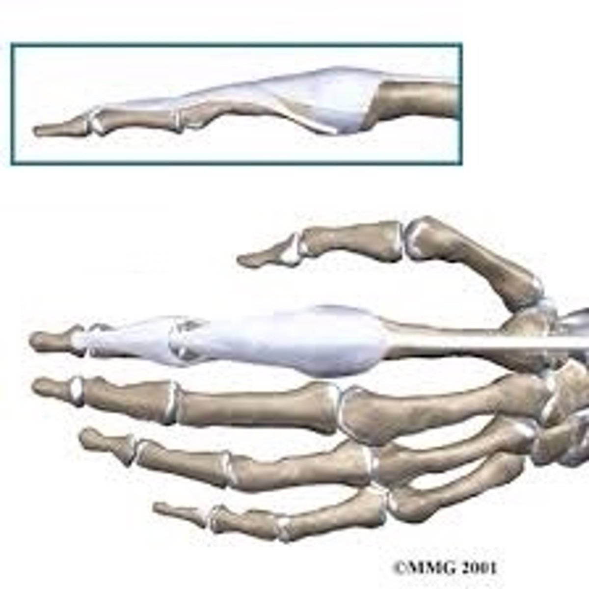 <p>Specialized connective tissue structure by which the extensor tendons insert onto the phalanges</p><p>AKA:</p><p>-Extensor Aponeurosis</p><p>-Extensor Hood</p><p>-Extensor Mechanism</p><p>-Dorsal Hood</p>