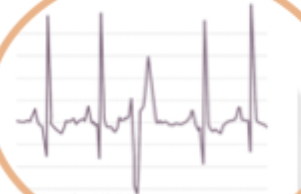 <p>What rhythm is shown?</p>