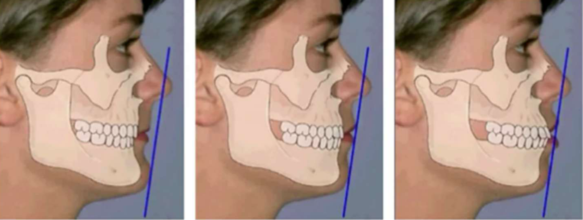 <p>which is normal, protrusive, and retrusive S-line</p>