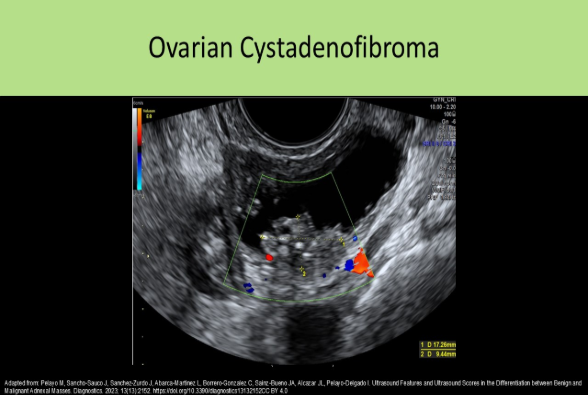 <p>Cystadenofibroma is composed of epithelial and stromal tissues of the ovary. Epithelial cells make up the cystadenoma. A thecoma is composed of theca cells.</p>