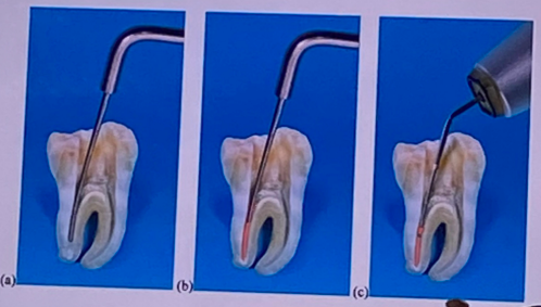 <p>uses injected <span style="color: red;">thermoplasticized gutta-percha</span> via a delivery system (ex: <span style="color: red;">Obtura III, Calamus</span>)</p>