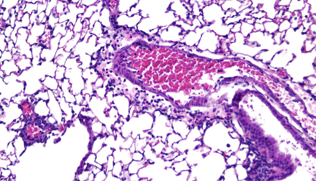 <p>What level of severity is shown?</p>
