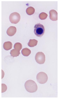 <p>Evidence of damaged red cells</p>