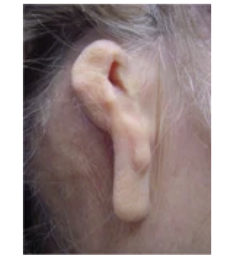 <p>Congenital abnormality where external ear does not fully develop</p>