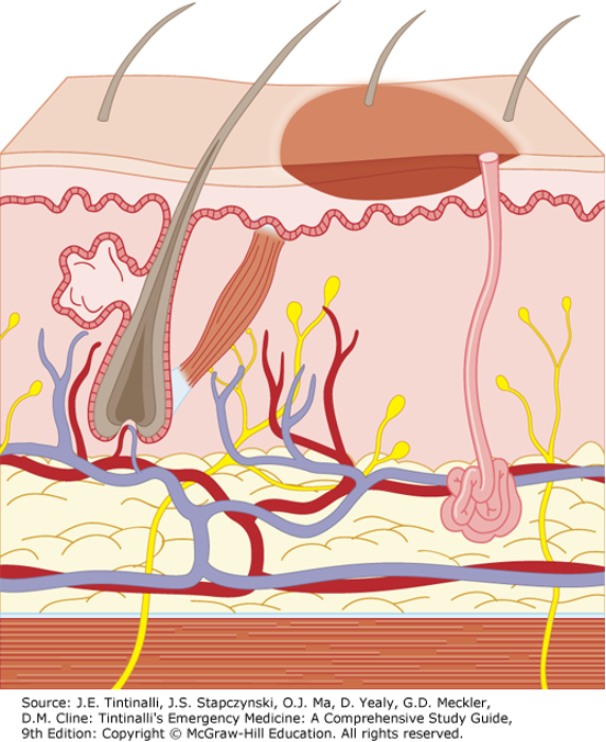 <ul><li><p>Only involves <strong>epidermal</strong> layer of the skin</p><ul><li><p>Ex: sunburn</p></li></ul></li><li><p>Burned skin is red, painful, and tender <strong>without</strong> blister formation</p></li><li><p>Usually heals in 7 days without scarring</p></li><li><p>Treatment → symptomatic</p></li></ul><p></p>