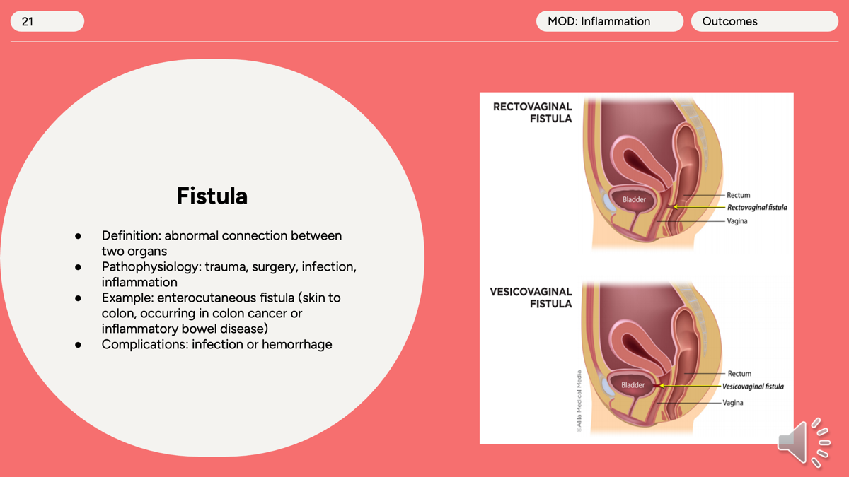 <p>Fistula</p><p><span>trauma, surgery, infection, inflammation. </span></p><p></p><p><span>enterocutaneous fistula (skin to colon, occurring in colon cancer or inflammatory bowel disease)</span></p><p></p><p><span>Infection or hemorrhage</span></p>