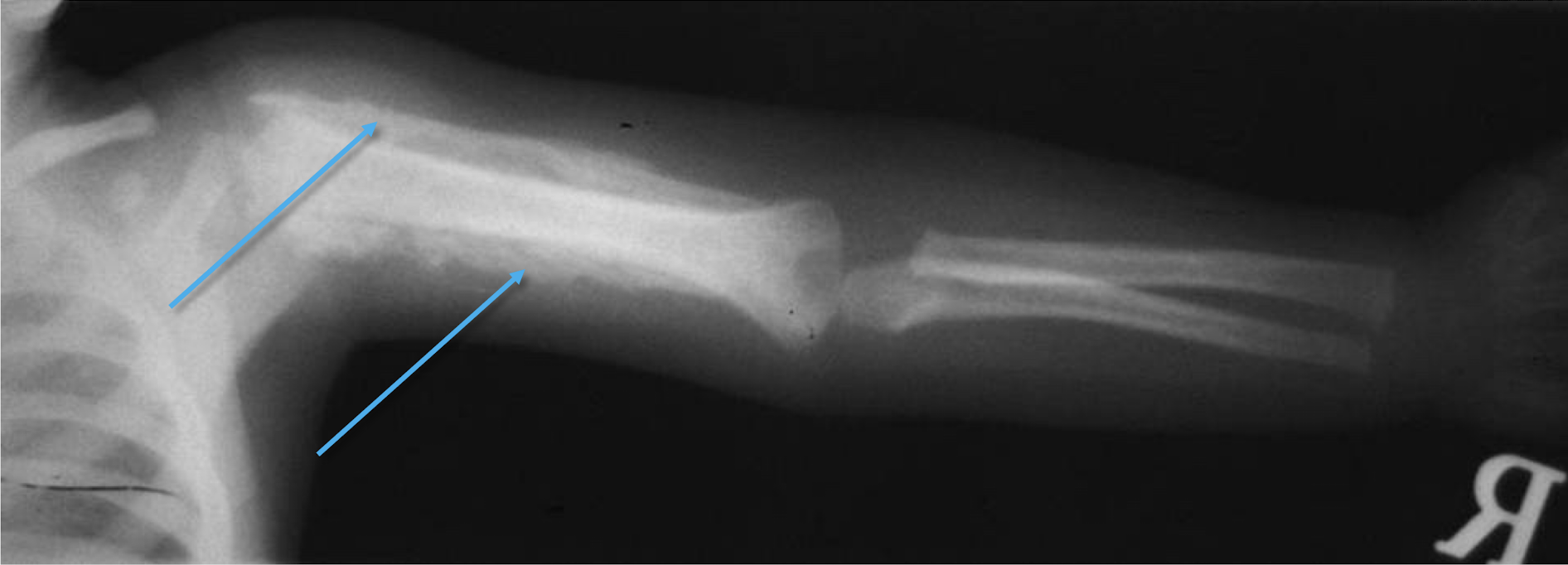 <p>What syndrome is this? What sign can be seen?</p>