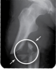 <p>shattering of affected area into many bony fragments</p>