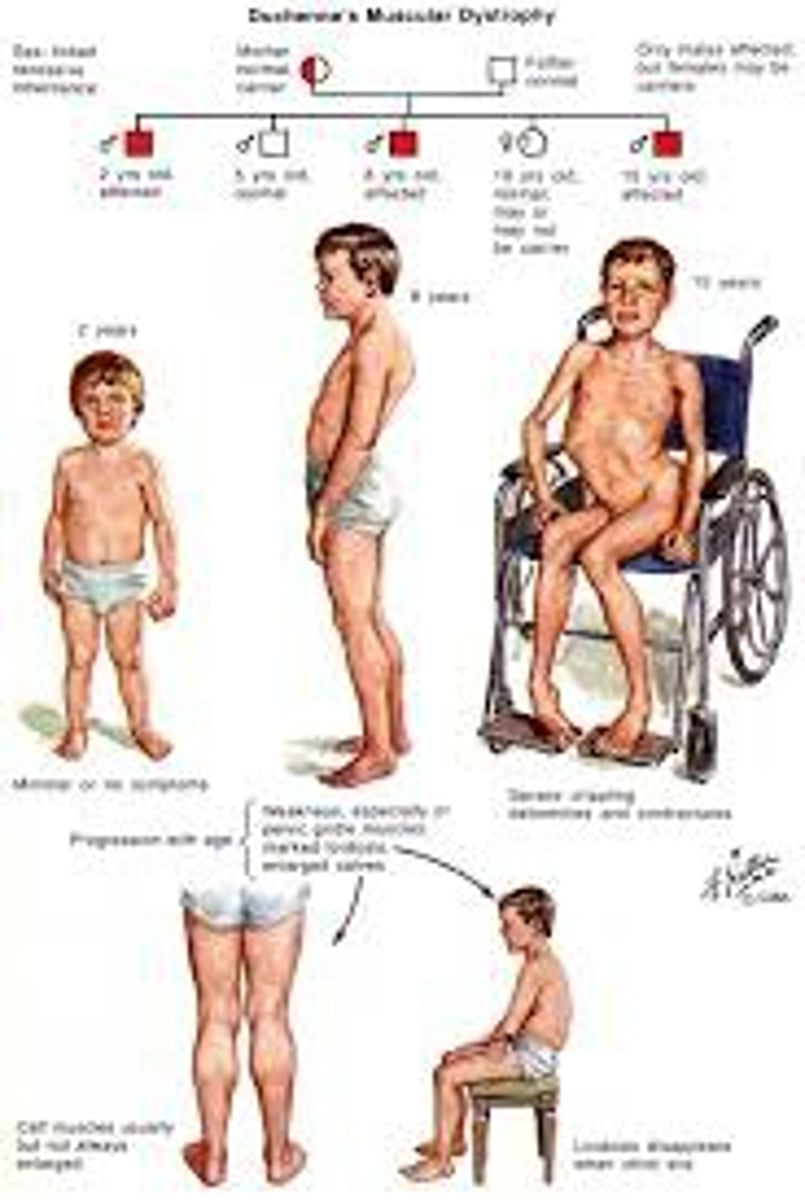 <p>- Its condition is a Fatal disease usually found in males, marked by muscle weakness and minor intellectual disability; respiratory failure and death usually occur in young adulthood</p><p>- Those who are at risk are 1 in 3,000 to 5,000 male births</p><p>- However, it cant be treated because there is no treatment.</p>