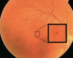<p>True or False: The microaneurysms associated with NPDR is actually hemorrhages within the retina</p>