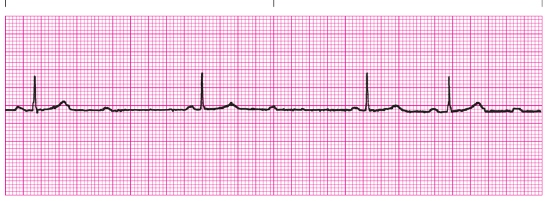<p>QRS?</p>