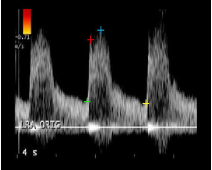<p>Which two cursors would be used to measure the velocities used to calculate the resistive index?</p>