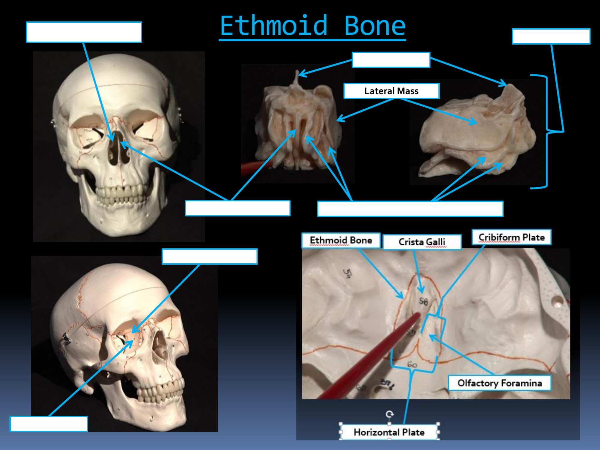 <p>Lateral Mass</p>