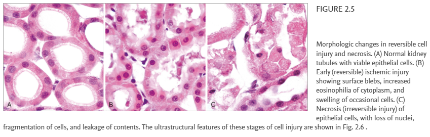 <p><span style="background-color: transparent; font-family: "Times New Roman", serif;"><strong>Increased Eosinophilia:</strong> </span><br><span style="background-color: transparent; font-family: "Times New Roman", serif;">Dead cells look "pinker" on hematoxylin & eosin stains because they lose RNA which binds the blue hematoxylin (which is blue) and accumulate denatured proteins (which are red). Eosinophilia = increased pink/red staining with eosin.</span></p><table style="min-width: 50px;"><colgroup><col style="min-width: 25px;"><col style="min-width: 25px;"></colgroup><tbody><tr><td colspan="1" rowspan="1"><p><strong>RNA is lost/degraded</strong></p></td><td colspan="1" rowspan="1"><p>↓ binding of <strong>hematoxylin (blue/purple)</strong> → less blue</p></td></tr></tbody></table><table style="min-width: 50px;"><colgroup><col style="min-width: 25px;"><col style="min-width: 25px;"></colgroup><tbody><tr><td colspan="1" rowspan="1"><p><strong>Proteins become denatured</strong></p></td><td colspan="1" rowspan="1"><p>↑ binding of <strong>eosin (pink/red)</strong> → more pink</p></td></tr></tbody></table><p></p>