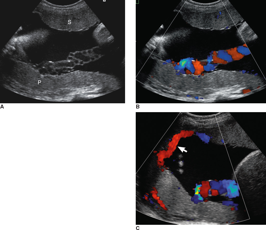 <p> additional smaller lobes located separate from the main segment of the placenta </p>