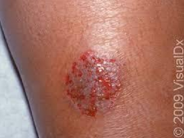 <p>Describe this lesion</p>