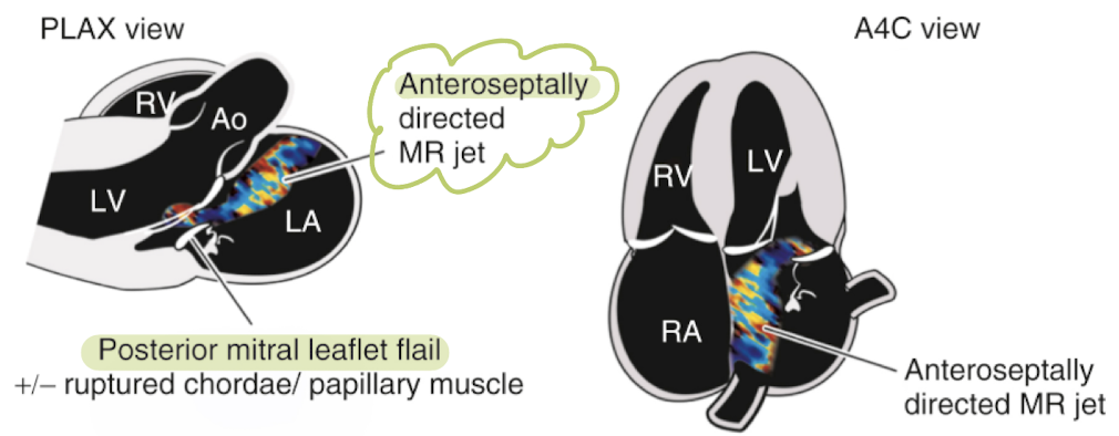 <p>anteroseptal MR</p>