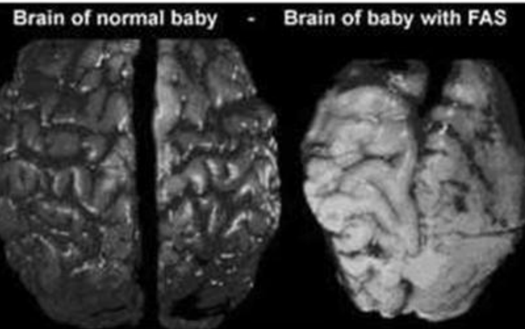 <ol><li><p>Smaller size of brain </p></li><li><p>Bigger ventricles (holes in the brain) </p></li><li><p>Fewer/flatter gyri (brain squiggles)</p></li></ol><p></p>