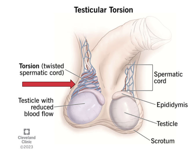 <p>Twisting of the <strong>spermatic</strong> <strong>cord</strong> that interrupts blood flow to the testicle, causing ischemia and potentially necrosis.</p><ul><li><p>Generally in younger populations (adolescents, feel embarrassed, delayed care, walk like duck, thorough physical exam + doppler, let dr know)</p></li></ul><p></p>