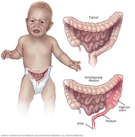 <p>Hirschsprung disease</p>