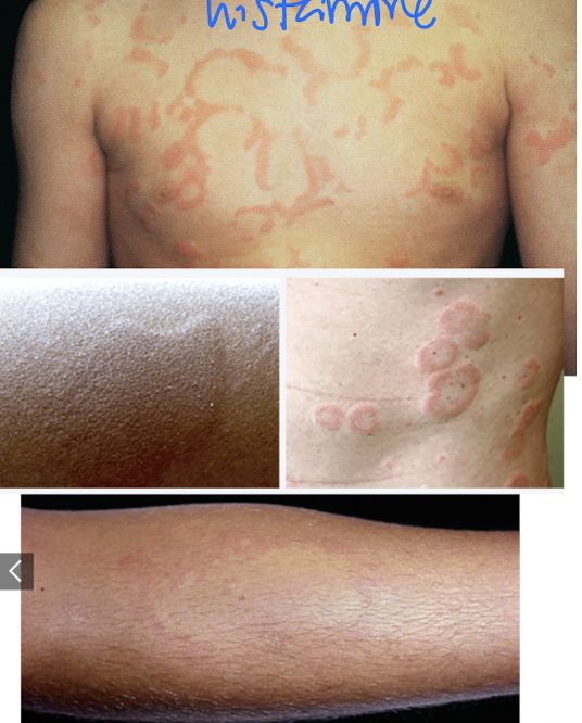 <p>Acute eruptions of itchy raised wheals surrounded by erythema.</p>