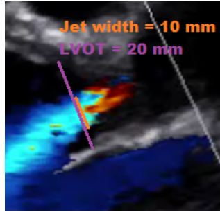 <ul><li><p><strong>Jet width: </strong>width of AI jet as it travels through LVOT area</p></li></ul><p><u>Steps:</u></p><ol><li><p>Zoom in LVOT with colour</p></li><li><p>Freeze frame with AI jet</p></li><li><p>measure width of AI jet in LVOT area (same location as LVOT diameter)</p></li><li><p>Divide jet width by LVOT diameter to get percentage:</p><ul><li><p>Calculate: (Jet width)/(LVOT diameter) * 100</p></li></ul><p></p></li></ol><p></p>