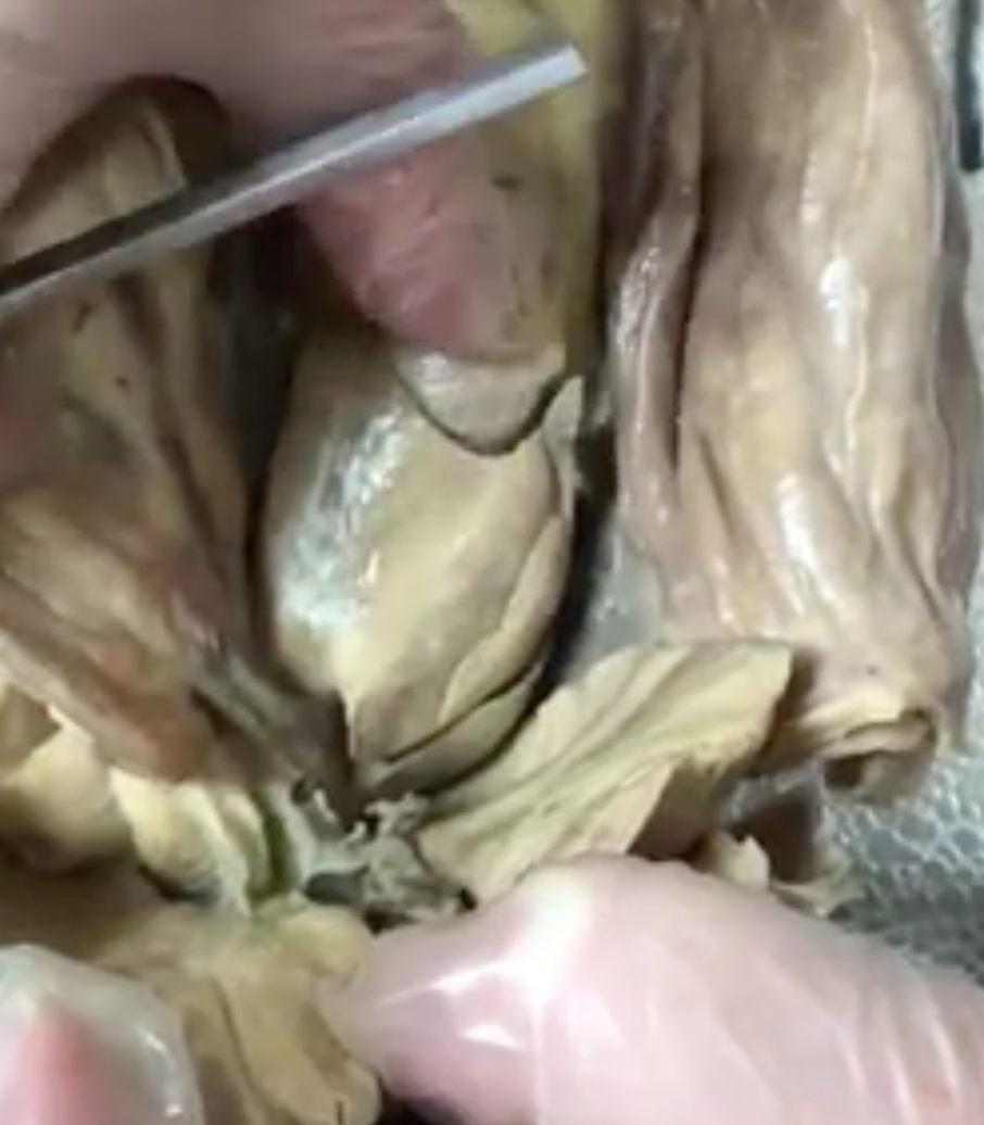 <p>what membrane of the liver is her thumb below</p>
