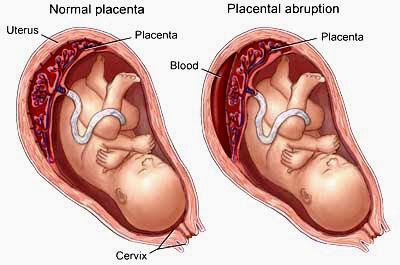 <p>premature separation of a normally implanted placenta from the uterus before full term</p>