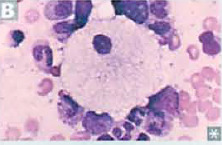 <p>Niemann-Pick disease (sphingomyelinase deficiency)</p><p>Foam cells</p>