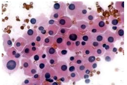 <p>1) Diagnostic cytologique bethesda</p>