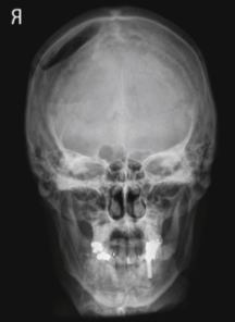 <p><span style="background-color: transparent;">PA Caldwell skull</span></p>