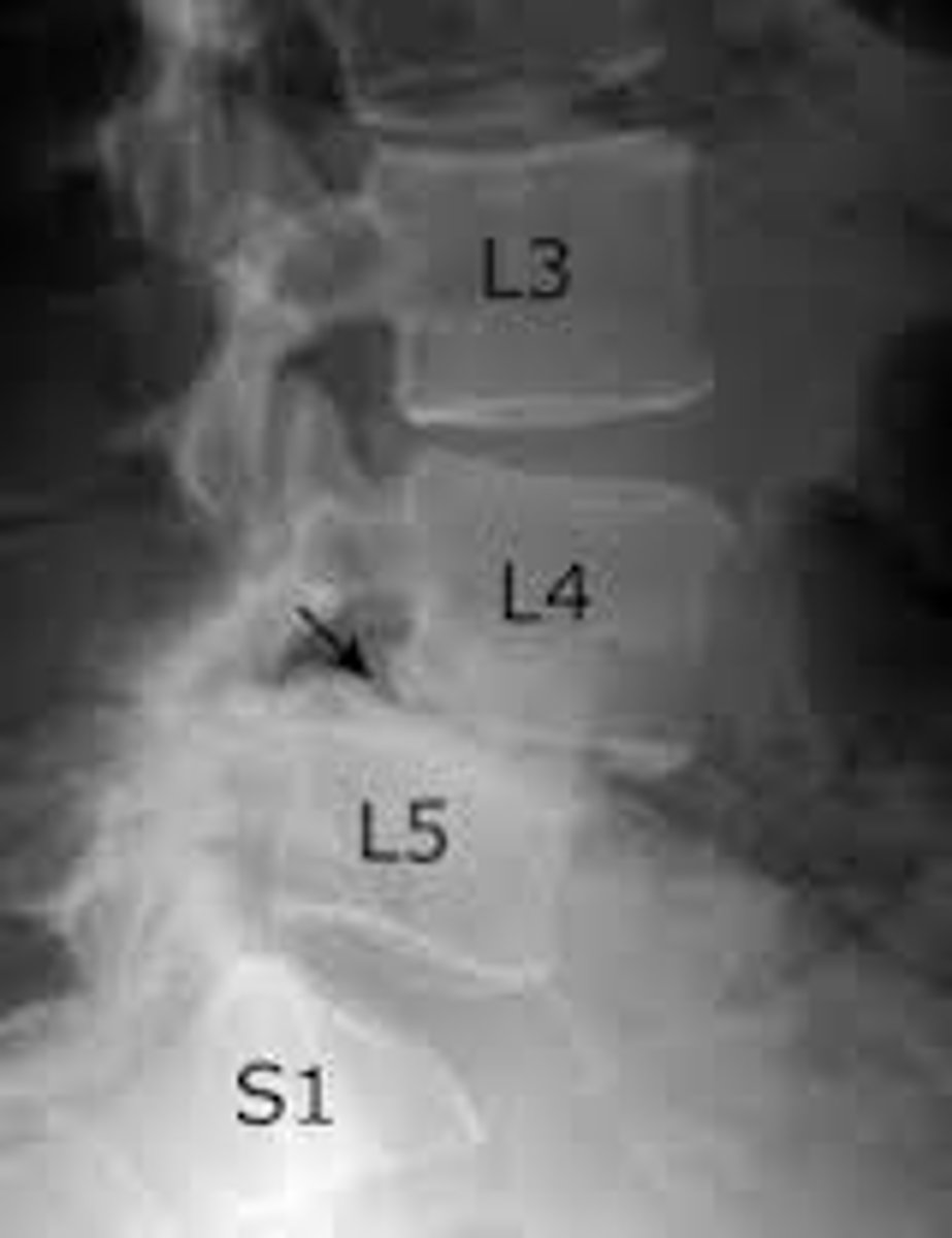 <p>= translation</p><p>movement of superior vertebrae relative to inferior vertebrae</p>