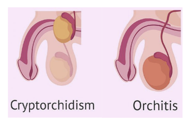 <ul><li><p>cryptorchidism</p></li><li><p>testicular torsion</p></li><li><p>orchitis</p></li></ul><p></p>