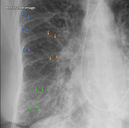 <p>What classic chest radiograph finding is indicative of pulmonary edema due to congestive heart failure?</p>