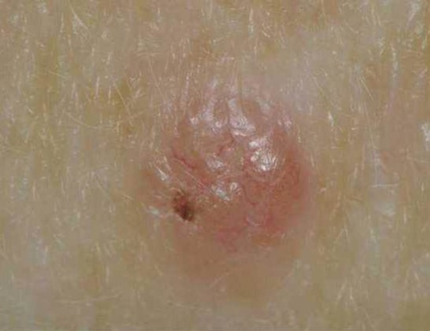 <p>A most common and least severe type of skin cancer; often characterized by light or pearly nodules.</p>