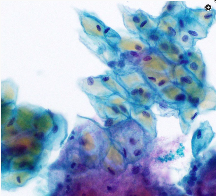 <p>Which characteristic cell is seen in this pap smear</p>