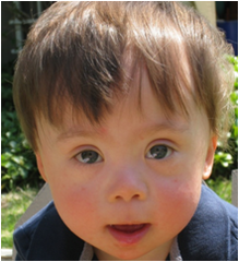 <p>- 3 copies of chromosome 21 → Down syndrome</p>