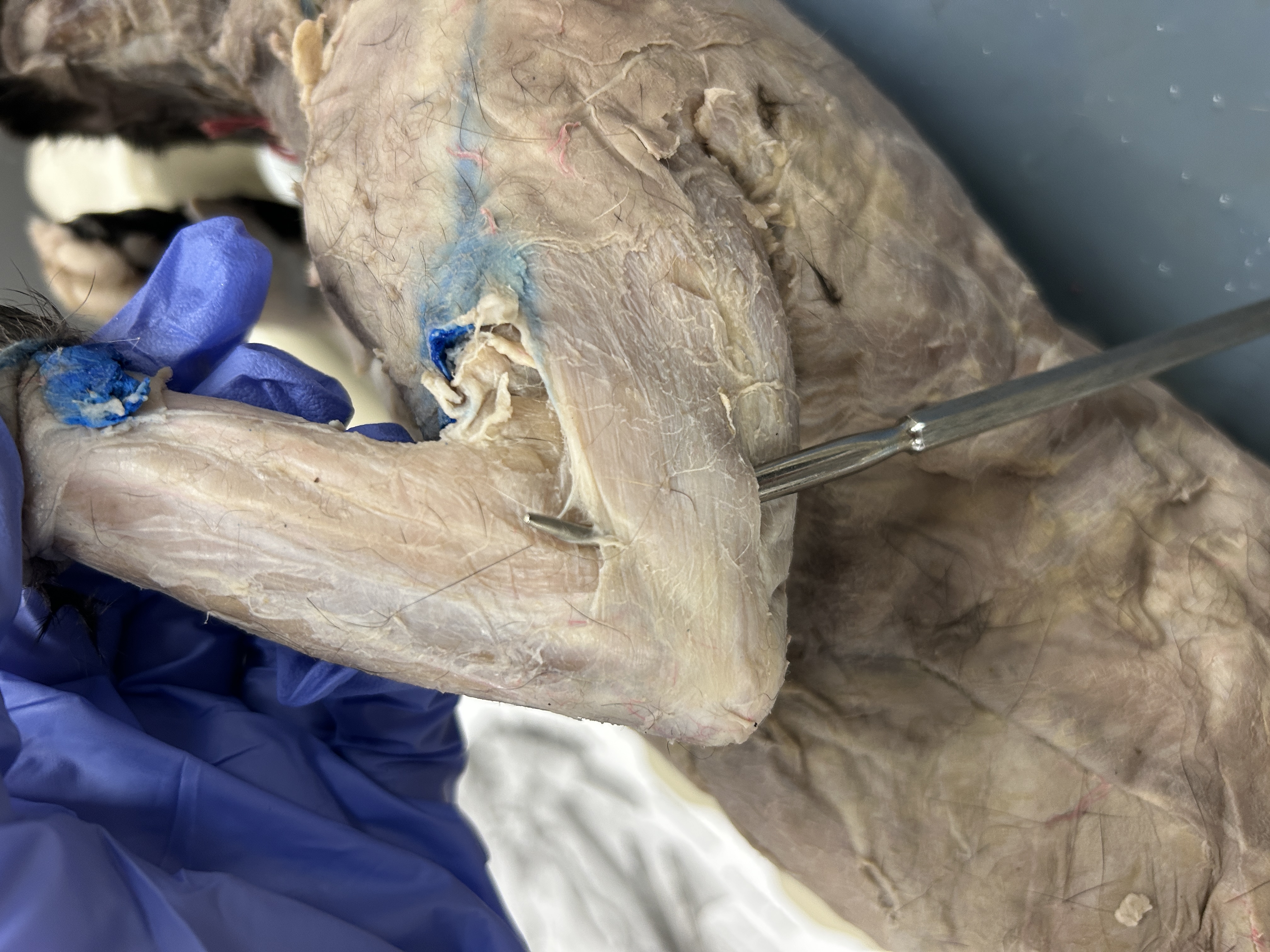 <p>Tricep Brachii long head (back of arm) </p>