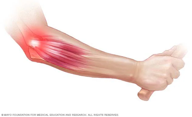 <ul><li><p>Overuse/force overload injury d/t degeneration of common extensor tendon (most commonly the ECRB) along the lateral epicondyle of the humerus</p><ul><li><p>Typically aggravated by repetitive lifting with arms extended and palms down</p></li></ul></li></ul><p></p><p></p>