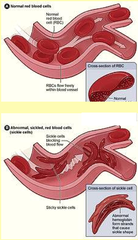 <p>Sickle cell anemia is a genetic disease caused by a single amino acid substitution (Glu to Val in position 6) in each beta chain of hemoglobin. </p><p>When oxygen is bound, both Hemoglobin A (normal) and Hemoglobin S are soluble, but in the deoxygenated form</p><p>Hemoglobin S (but not Hemoglobin A) becomes very insoluble, due to exposure of the hydrophobic</p><p>valine residue. This exposed "patch" causes aggregation of deoxy-Hemoglobin S into long insoluble fibrous aggregates, resulting in distorted shapes of the red blood cells (and leading to the symptoms of the disease).</p><p>Heterozygous individuals, however, have no health problems and exhibit a resistance to MALARIA</p>