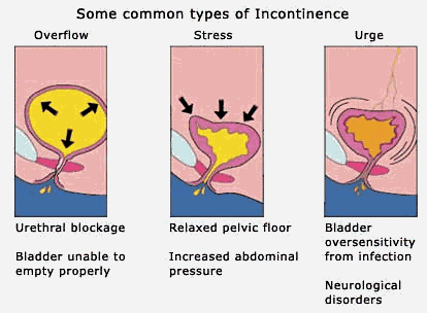 <p>- urethra overactive (closes)</p><p>- bladder underactive (relaxed)</p><p>overfilled bladder that cant empty= leaks out</p><p>-sense of fullness, incomplete bladder emptying, frequency, straining</p>